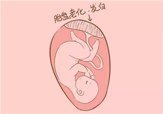 孕晚期胎盤老化能順產(chǎn)嗎 胎盤三級必須剖腹產(chǎn)嗎