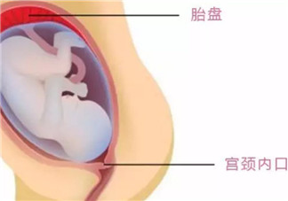 孕婦胎盤低怎么辦 孕婦胎盤低是什么原因造成的(胎盤低要注意什么)